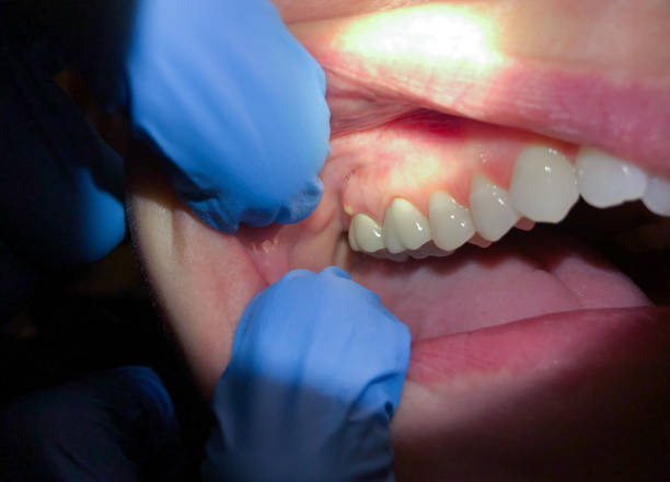 Best Emergency Treatment for Toothache in Oneonta, NY